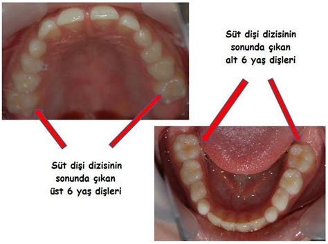 distorsiyon nedir diş